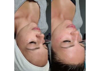 Maple Ridge med spa Beautiful You Laser