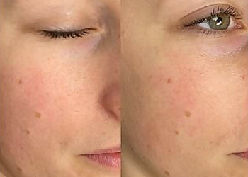 Breeze Laser MedSpa - Abbotsford, BC Med Spas - Before and After Image