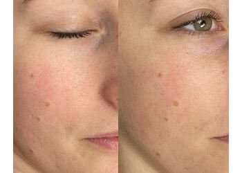 Abbotsford med spa Breeze Laser MedSpa