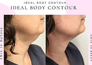 St Catharines weight loss center Ideal Body Contour