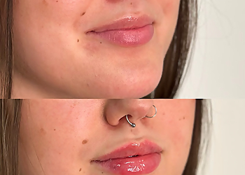 Scarlett and Lucy Med Spa - Saskatoon, SK Spa Médical - Before and After Image