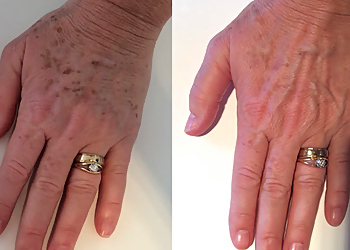 Tbeau Laser and Skin Rejuvenation Centre - Chilliwack, BC Med Spas - Before and After Image